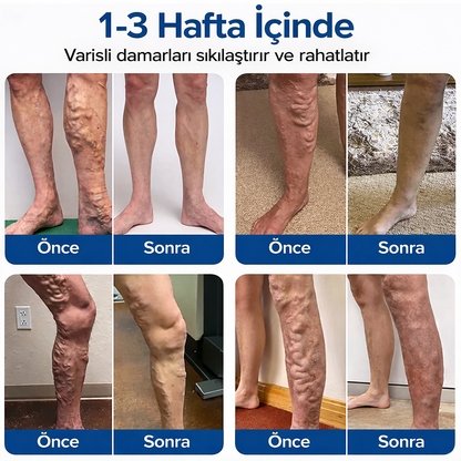 VALEGANSIA® Mikroiğneli Varis Bakım Bandı